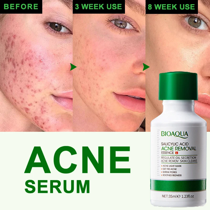 Salicylic Acid Acne Removal Serum Treatment Acne Product Shrink Pore Remove Blackheads Facial Cleaning Fade Acne Marks Whitening eelhoe melanin correcting serum fade dark spot freckle melasma removal whitening moisturize anti aging white truffle first spray