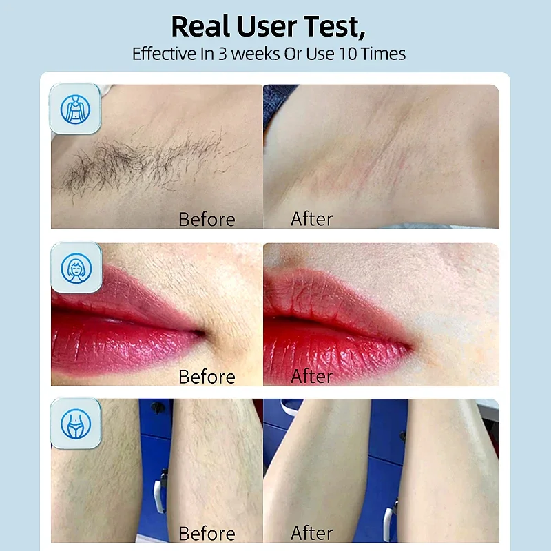 ماكينة إزالة الشعر بالليزر MLAY T14 IPL 500000 ومض...