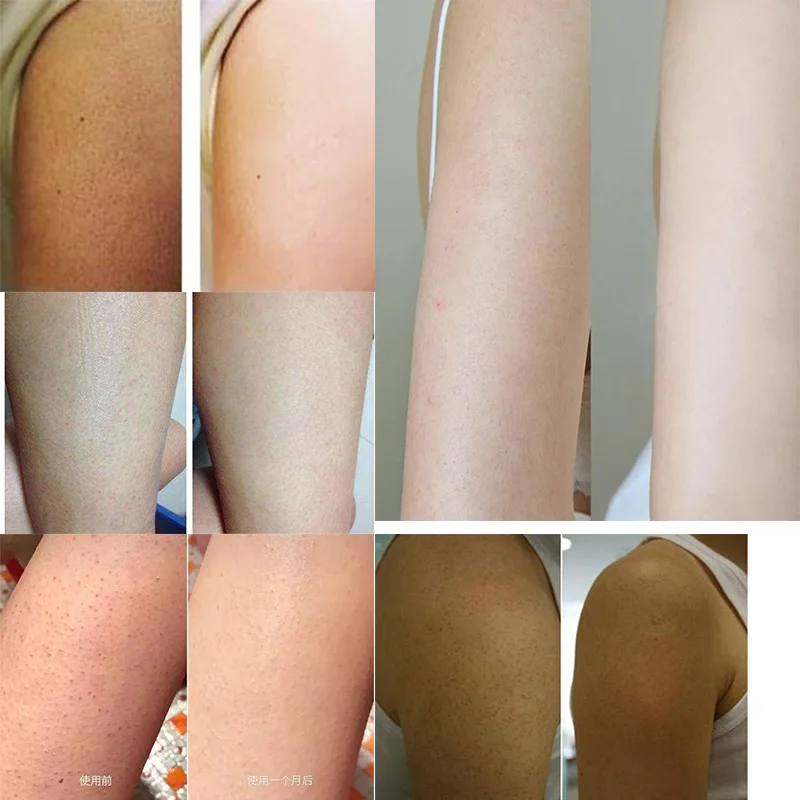300g/10.58 OZ Curing Keratosis Pilaris Chicken Skin Body Lotion Skin Repair Cream Skin Care Essence Moisturizing And Nourishing 6