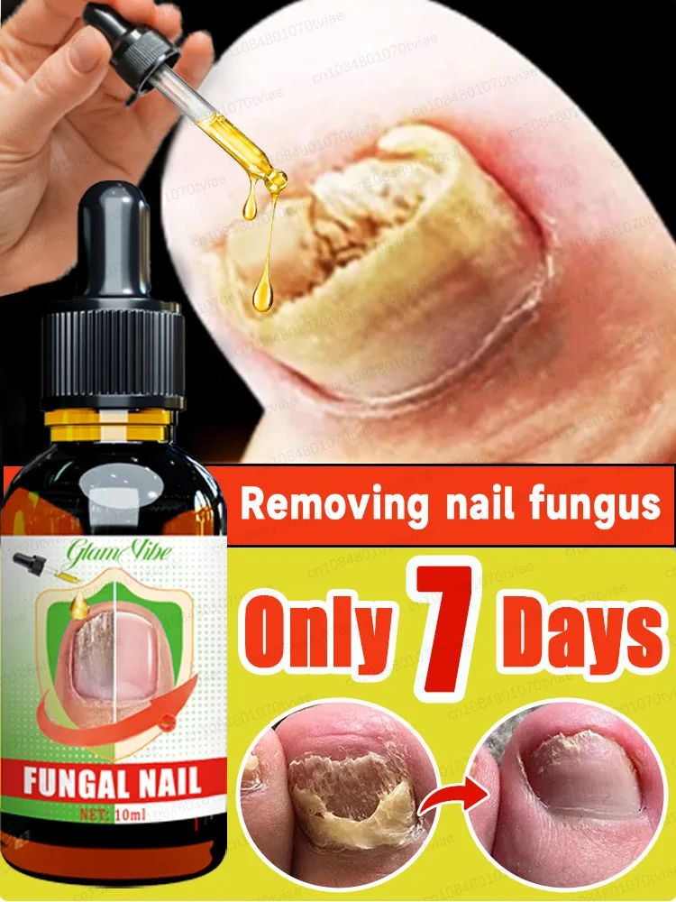 Fungus Solution Organic Essential Oil Toenail Nail Fungus Treatment Repair Fingerail Device Toenail Treatment for Foot Nail Fungus Essential Oil Onychomycosis Care