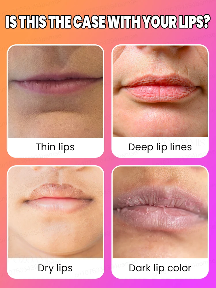 Lip Augmentation in one month