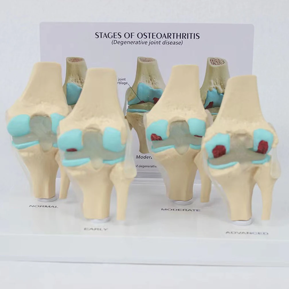 Four-Stage Human Pathological Knee Joint Anatomy Model Medical Science Teaching Resources Kit Models Dropshipping