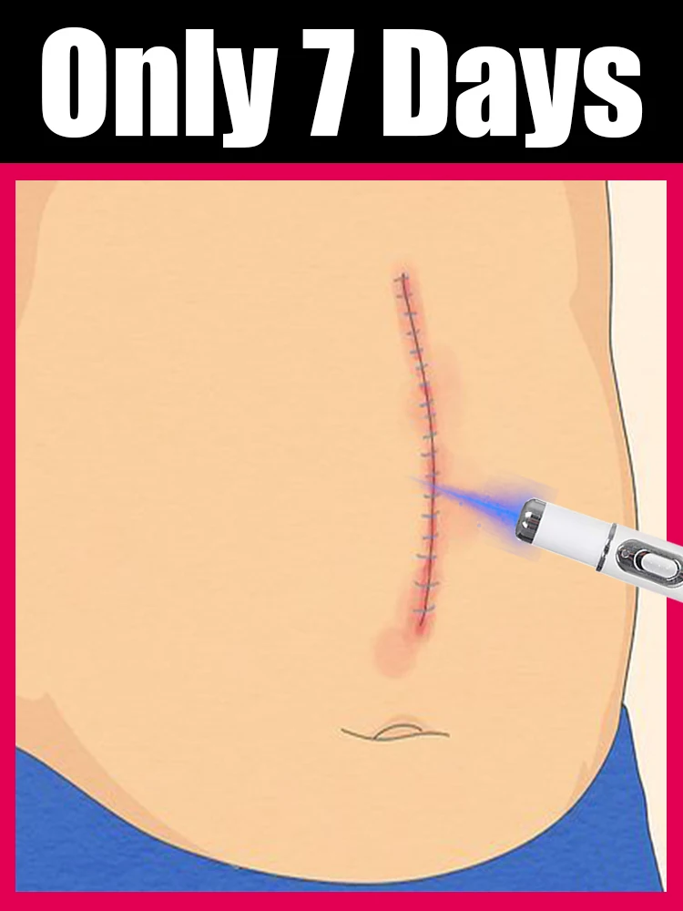 ชุดเครื่องมือลดรอยแผลเป็นสีฟ้า สามารถลดรอยแผลเป็นแบบแบนและรอยแผลเป็นแบบเส้นใยได้ 1