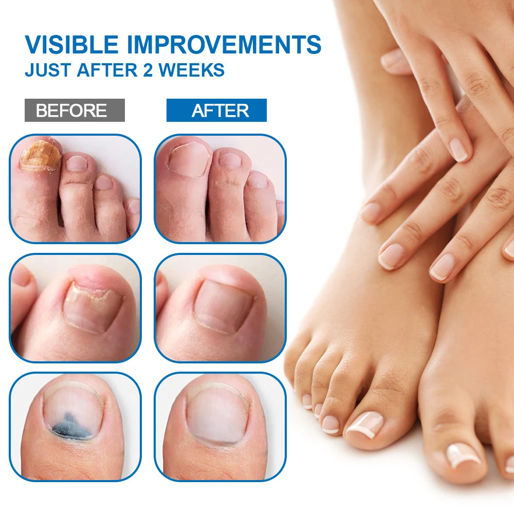 Nail Fungus Laser Treatment Device Care Tool