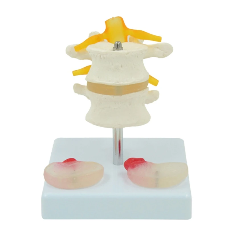 

Anatomical Lumbar Vertebra Model for Demonstrating Pathological Lumbar Disc