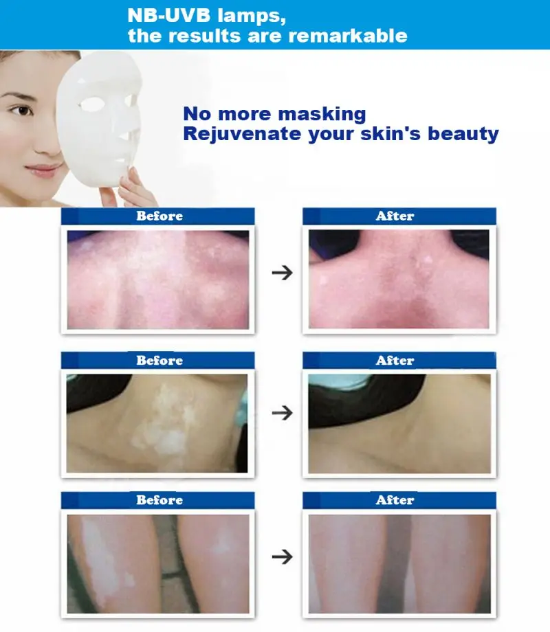 UV 311nm Ultraviolet Phototherapy Device Uses Philips Lamp UVB To Treat Vitiligo Psoriasis White Spots And Skin Diseases uv phototherapy lamp