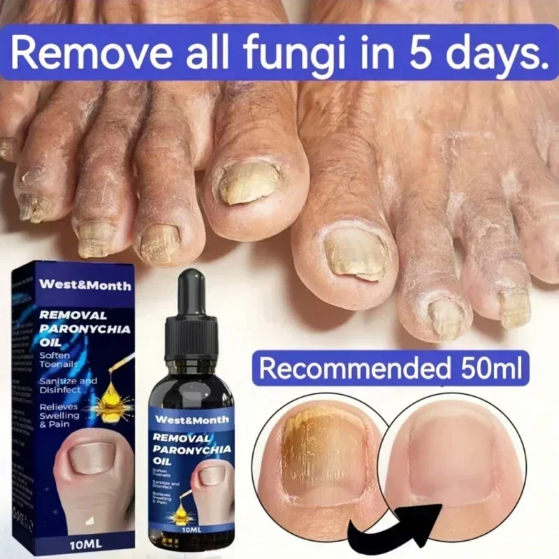 Toenail Paronychia Treatment Recovery Relief Nail Rejuvenation Foot Profession Care,nail fungus treatment,nail care kit