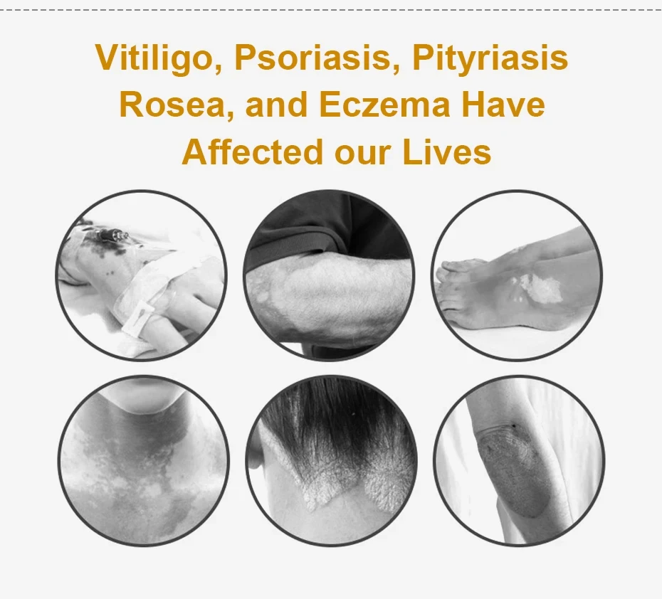 Vitiligo Therapy Device Psoriasis Skin Treatment Light 311nm Narrowband Ultraviolet Phototherapy Instrument UVB Lamp 2