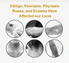 Vitiligo Therapy Device Psoriasis Skin Treatment Light 311nm Narrowband Ultraviolet Phototherapy Instrument UVB Lamp 2