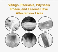 Vitiligo Therapy Device Psoriasis Skin Treatment Light 311nm Narrowband Ultraviolet Phototherapy Instrument UVB Lamp 2