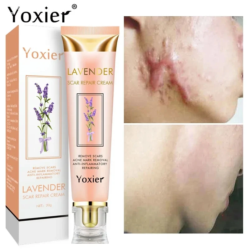 

Fast Scar Repair Cream Removal Stretch Marks Burns Acne Spot Moisturizing Scars Treatment Whitening Smooth Skin Care