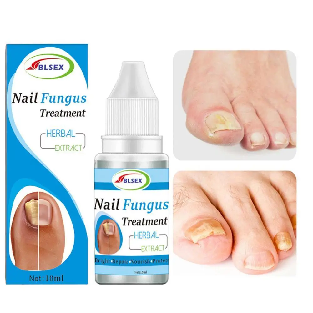 

Fungus Nails Treatment Toenails Repair Onychomycosis Paronychia Anti Infection Toe Nail Fungal Removal Liquid 10ml