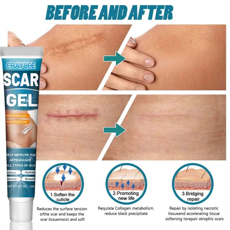 Liquid Bandage Spray ERAYCEE Thin Scar Gel Thin Scar Scald Abdominal Skin Care