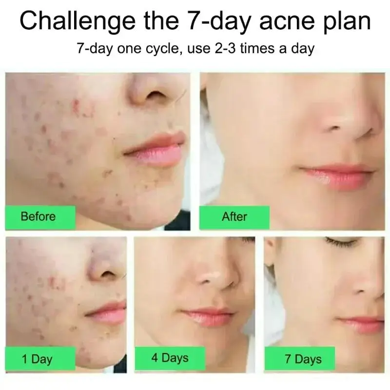Butt Thigh Face Acne Treatment Cream Repair Pimple Spots Bumps Skin Deep Cleaning Pore Clog Whiten Moisturizer Body Lotion 100ml moisturising lotion,whitening body cream,body lotion,whitening cream,brightening cream,body care,whitening serum,brightening body cream,body skin care cream