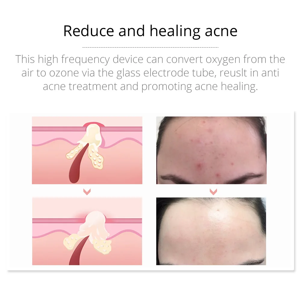 Darsonval Portable High Frequency Facial Machine Skin Therapy With 6 Neon & Argon Wands Remove Wrinkles Acne Facial Therapy Wand