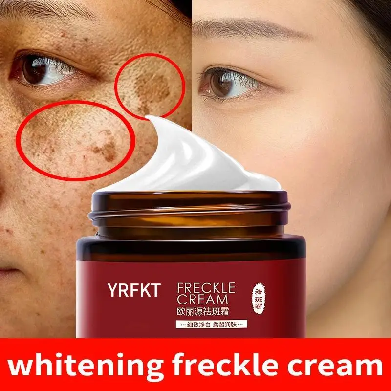 Whitening Freckle Cream Remove Melasma Spot Acne Pigment Melanin Dark Spots Pigmentation Freckle Removal Cream