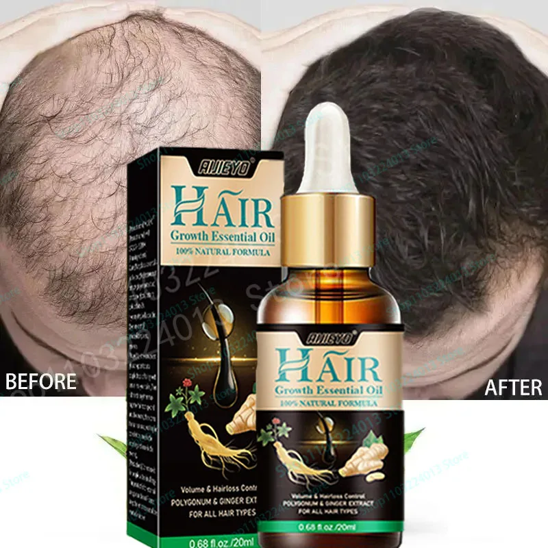 

Unisex Hair Growth Oil Hair Loss Treatment Rapid Hair Growth Effective Baldness Repair Stress Postpartum Scalp Damage