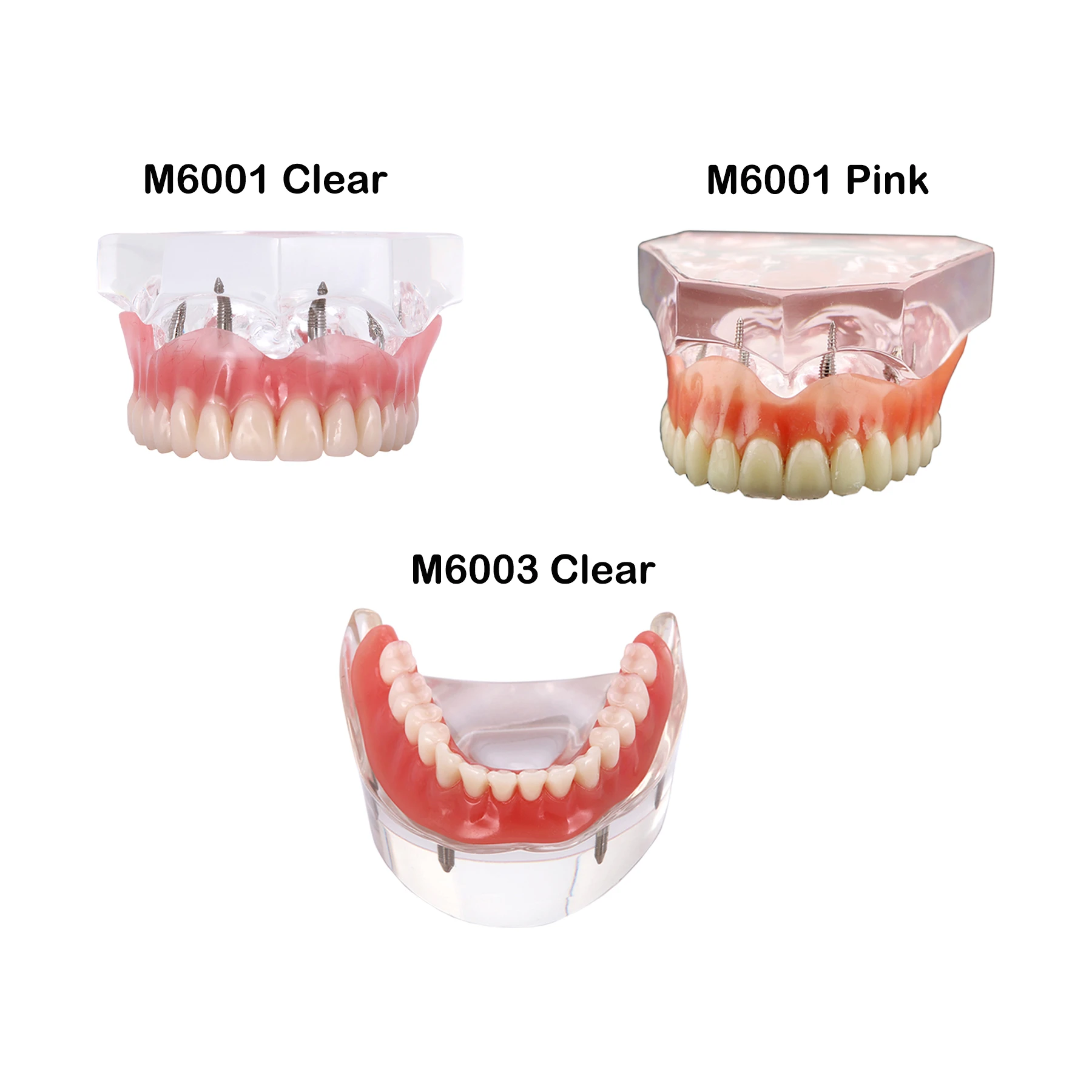 Dental Implant Teeth Model With 4 Implants Overdenture Restoration