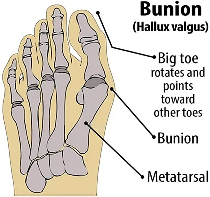    ߰ ܹ       ť 縻 Bunion , 2 