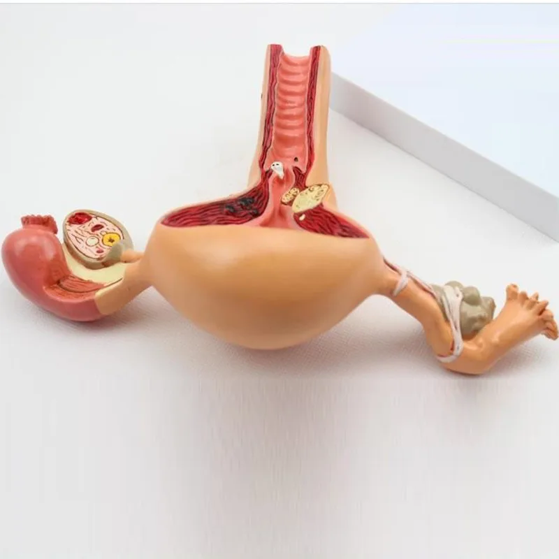 인간 자궁 해부학 모델, 자궁 병변 모델, 병적 자궁 모델, 자궁 난소 병변