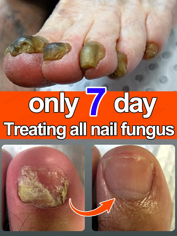 Nail Fungus Treatment Essential Oil Repair Onychomycosis 7 days