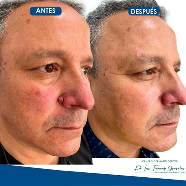 Jemeesen – crème anti-verrues pour hommes et femmes, sérum de traitement pour verrues, sans douleur, peau de taupe, taches foncées