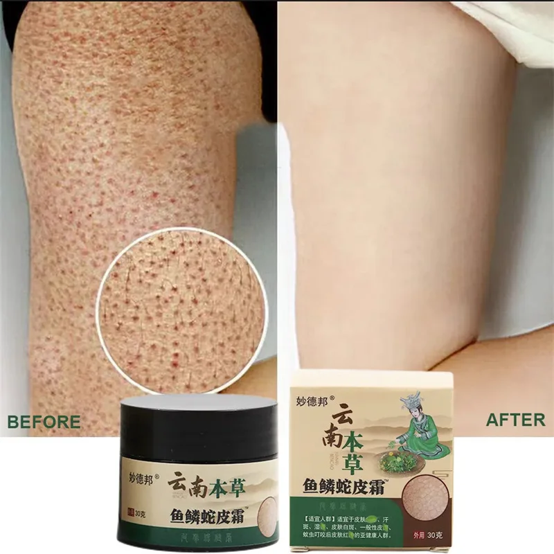 

Repair Chicken Cream Rough Thick Pore Curing Body Dark Spot Treat Keratosis Follicle Pilaris Lotion Dead Skin Remove Moisturizer