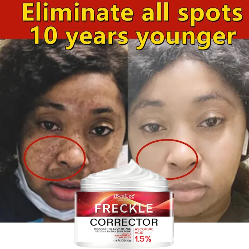 

Powerful Whiten Freckle Cream Black Dots Melasma Remover Anti Brown Stain Lighten Pigmentation Moisturizing Skin Care Products