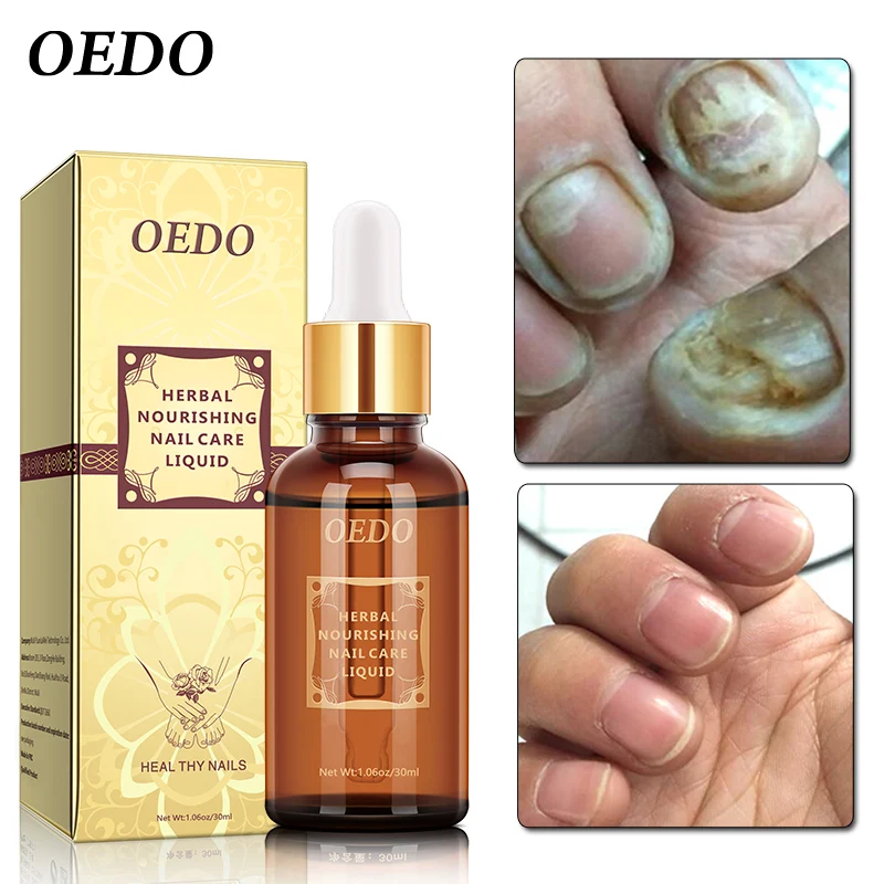 Fungal Nail Treatment Essential Oil Hand And Foot Whitening Toe Nail