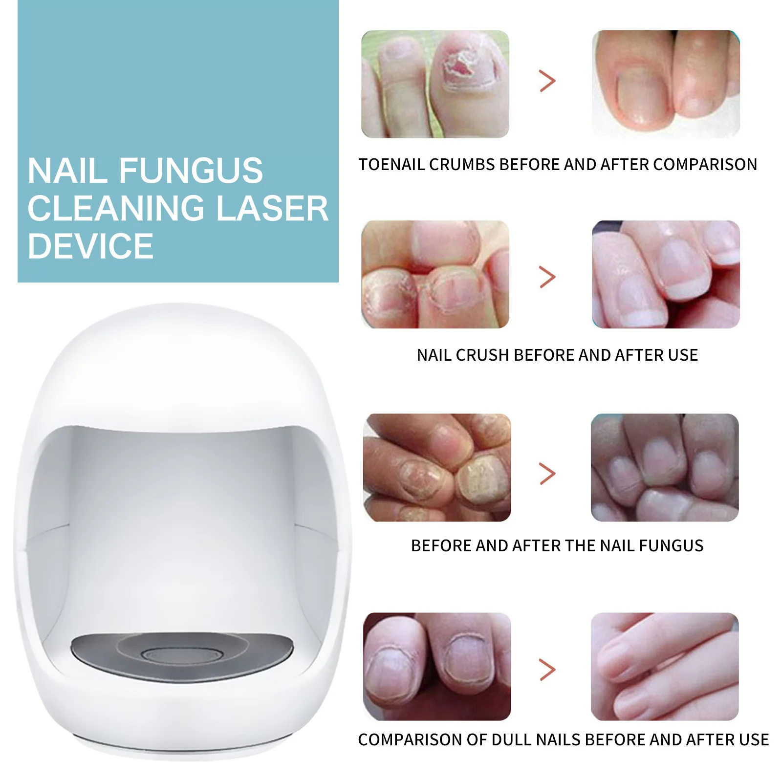 Laser Nail Fungus Treatment Device Repair Ingrown Toenail Fingernail Fungus Corrector Podiatry Mold Laser Nails with Mushrooms