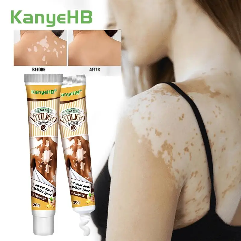 

2Pcs Vitiligo Ointment Pigment Growth Cream Remove White Spot Sweat Spot Cure Ringworm Skin Tinea Herbal Treatment Cream A1741