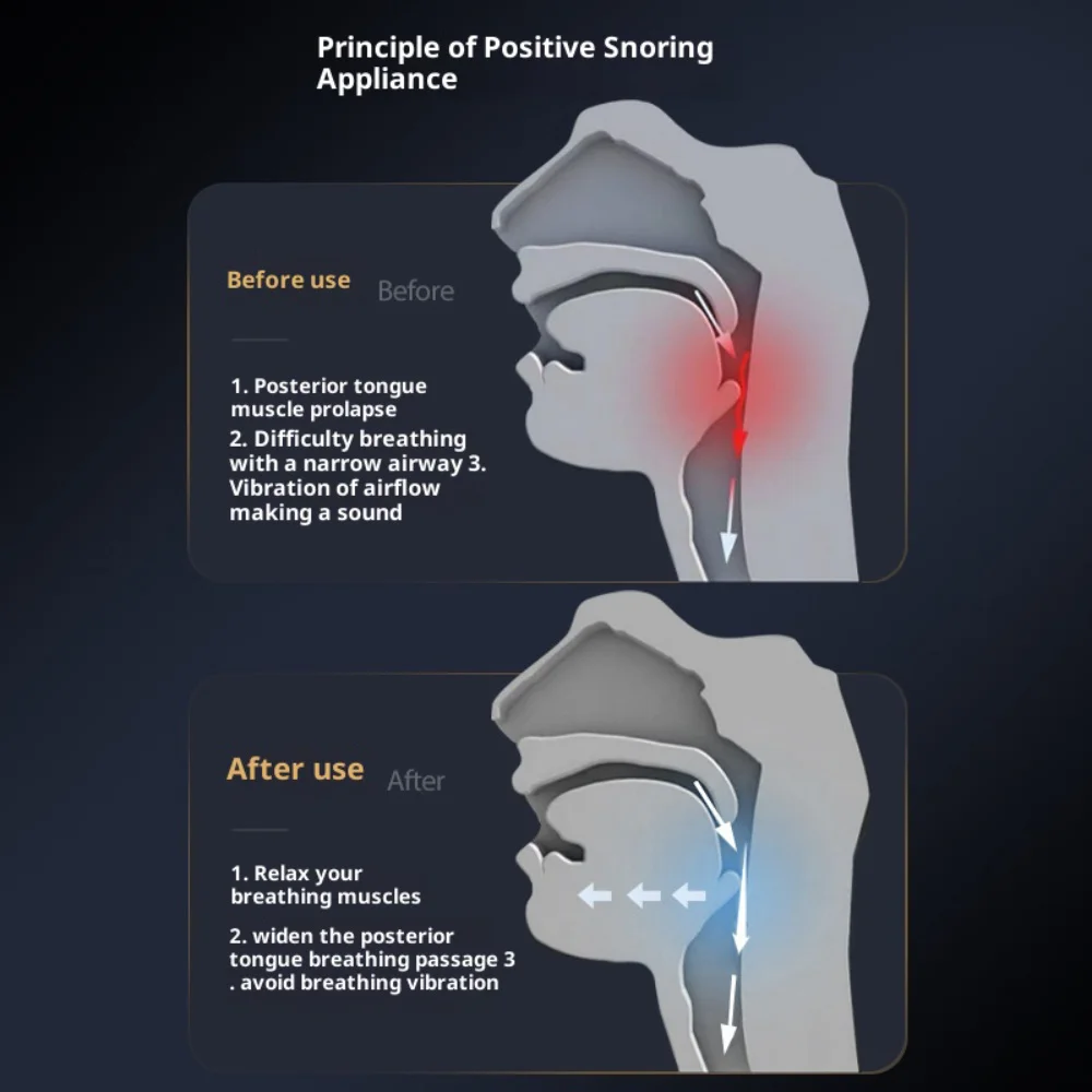 Electric Anti-Snoring Device Breathing Corrector Electric Anti Snoring Sleep Pro Ems Anti Snoring Device Night Device