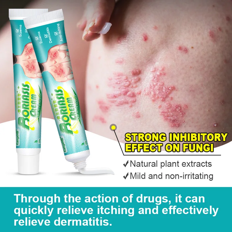 Psoriasis Cream Skin Moss Removal Cream Pityriasis Versicolor Sweat