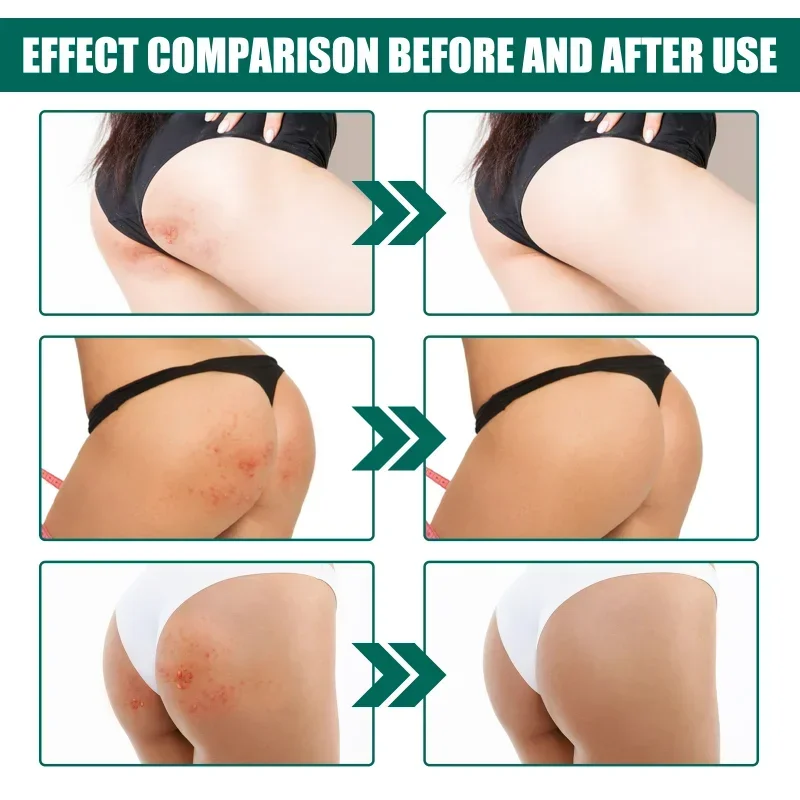 Butt acne Treatment cream gentle repair nourish Hip dilute Pimple Scar Removal body Acne Spot Moisturizing tender skin care