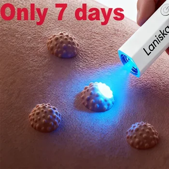 Blue Light Wart Removal Pen 1