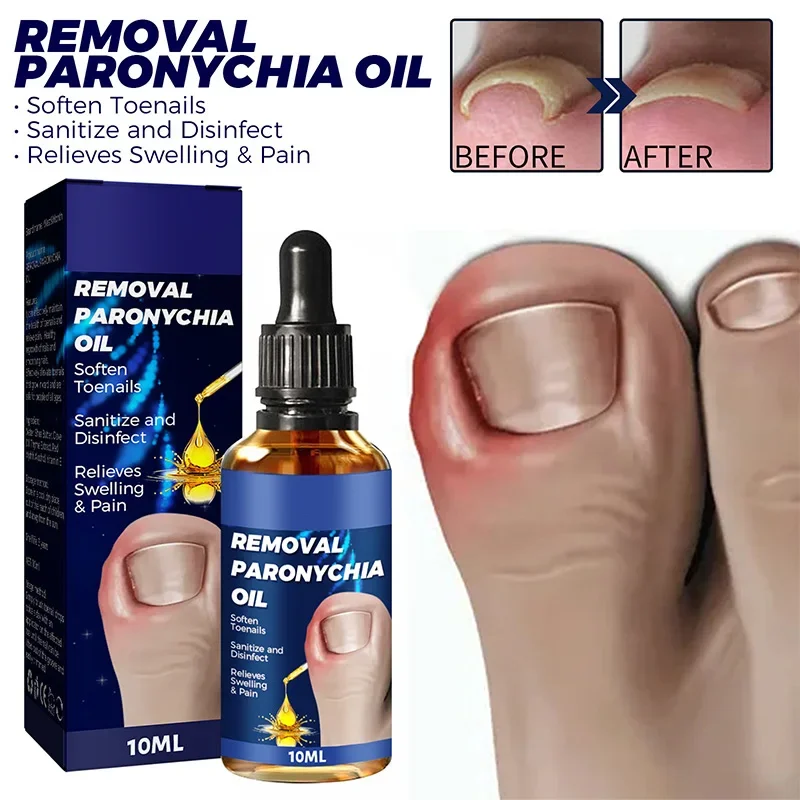 

Toenailcare Removal Paronychia Oil Ingrown Toenail Treatment Nail Renewal Liquid Bad Thicken Soft Repair Solution