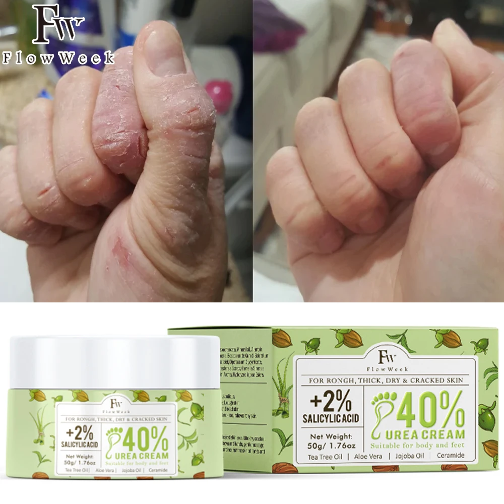 Urea Cream 40% with 2% Plus Salicylic Acid 1.76 Oz,Callus Remover Hand  Cream Foot Cream For Dry Cracked Feet,Hands,Heels,Elbows,Nails,Knees,Intensive  Moisturizes & Softens Skin,Exfoliates Dead Skin - Walmart.com