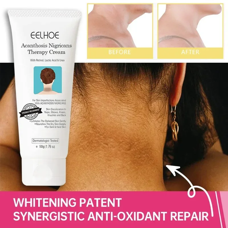 effective whitening freckle removing serum black spots reduces pigmentation anti aging moisturizing brightening skin care 60ml Black Acanthoderm Repair Cream Brighten Armpits Moisturizing Brightening Serum Improve Pigment Dullness Whitening Body Cream