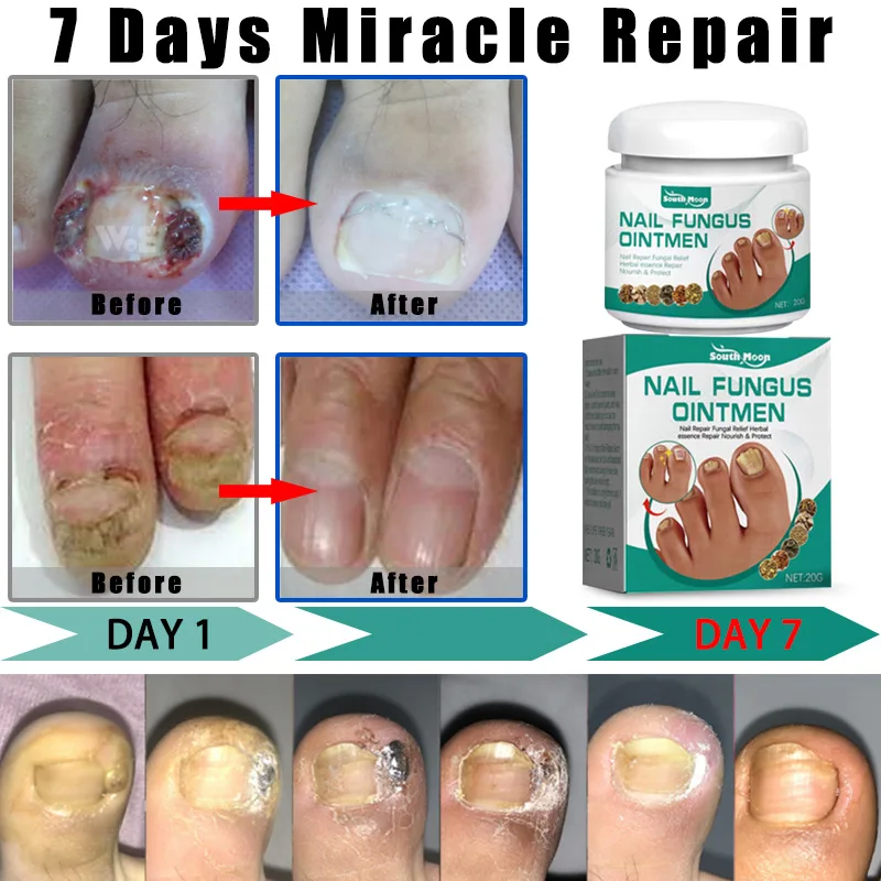 Nail Fungus Treatments Serum Cream Anti fungal Foot toe Nails Repair