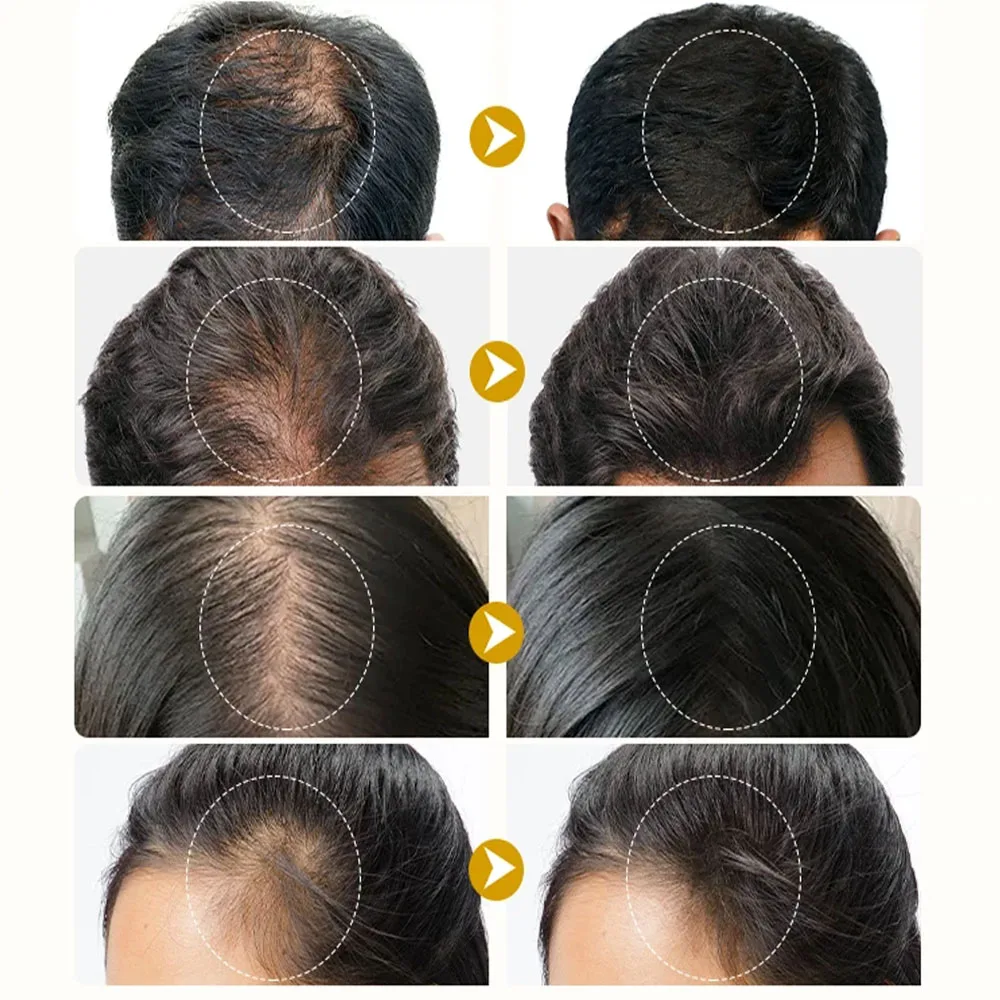 Hair Growth Serum Fast Ginger Hair Growth Spray Anti Hair Loss Regrowth Serum Scalp Damaged Repair Nourish Care for Women Men