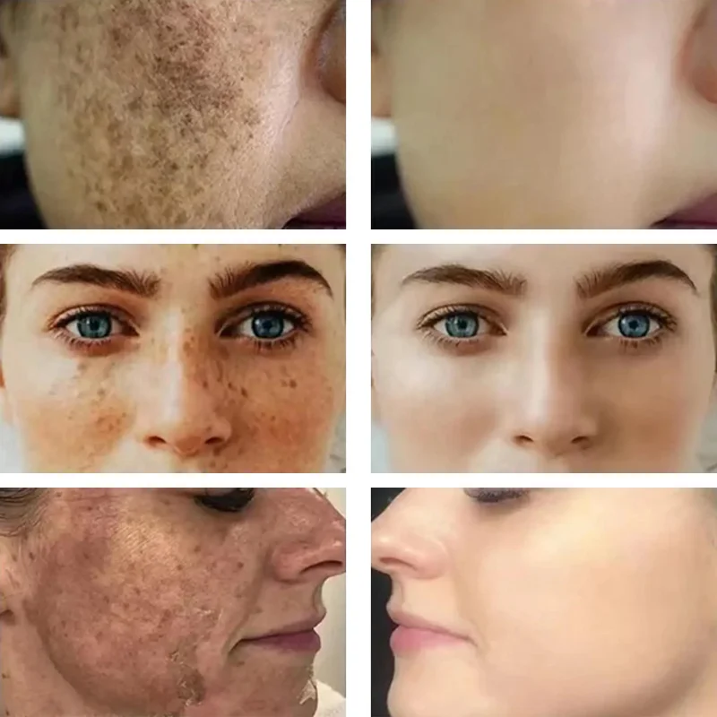 Dark Spots Remover Whitening Serum Face Freckle Melanin Correcting Anti Pigmentation Brightening Korean Day Night Skin Care 50ml facial serum facial essence