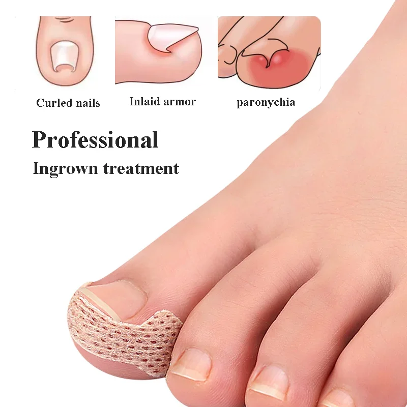 10/40pcs Nail Correction Stickers Ingrown Toenail Corrector Patches Treatment Manicure Recover Corrector Pedicure Care Tool ingrown toenail correction tool manicure pedicure tool set foot care tool foot pedicure tool foot care patches toe corrector nail problem solving