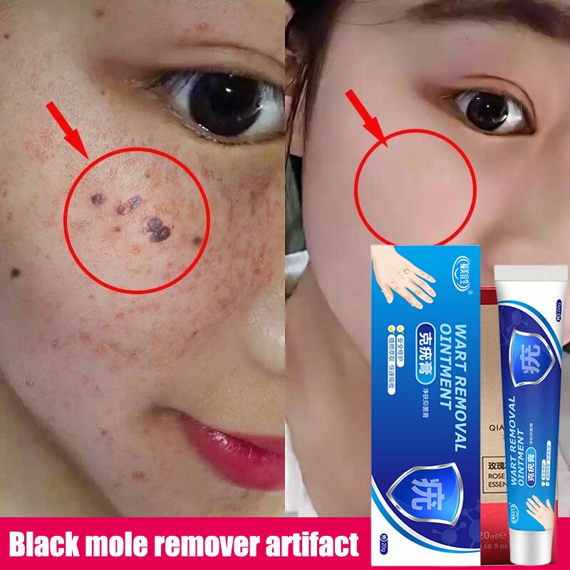 mole removal cream before and after