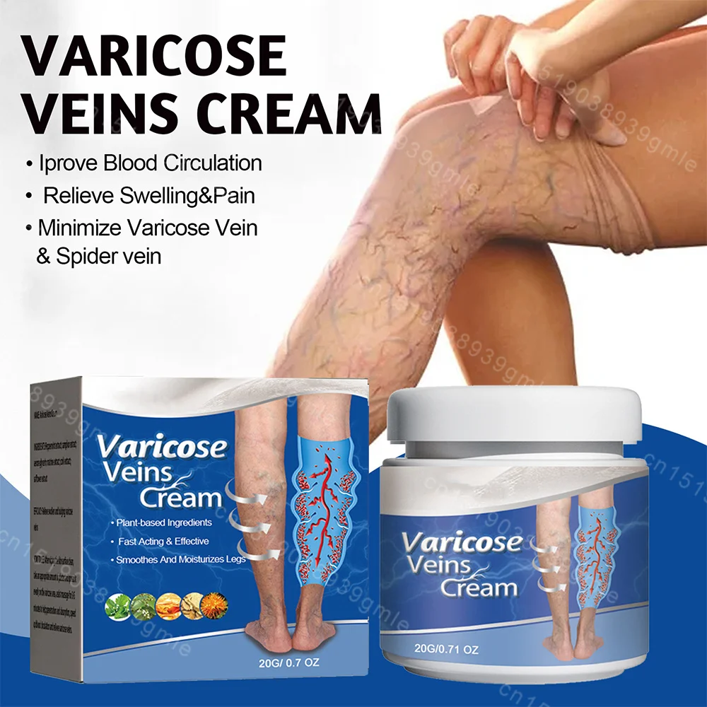Varicose Veins Treatment Cream Vasculitis Phlebitis Spider Pain Effective Relieves Leg Bulge Pain Improve Blood Circulation