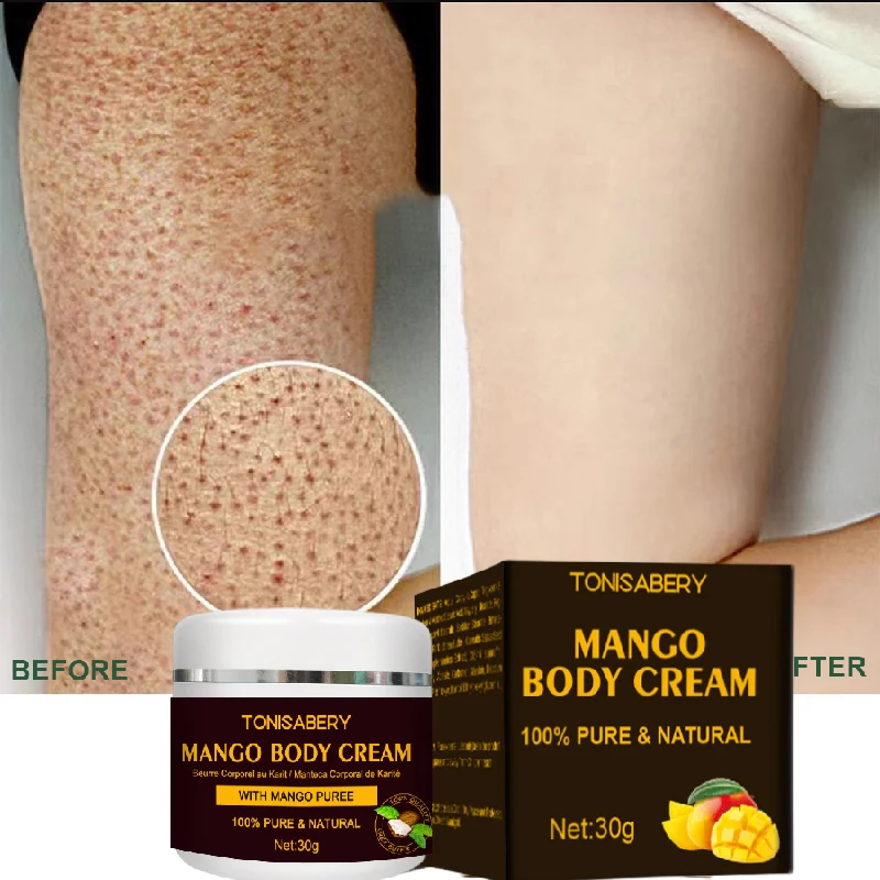 

Keratosis Pilaris Repair Treatment Cream Clearing Acne Spots Removal Chicken Skin Goose Bumps Deep Moisturizing Smooth Skin Care