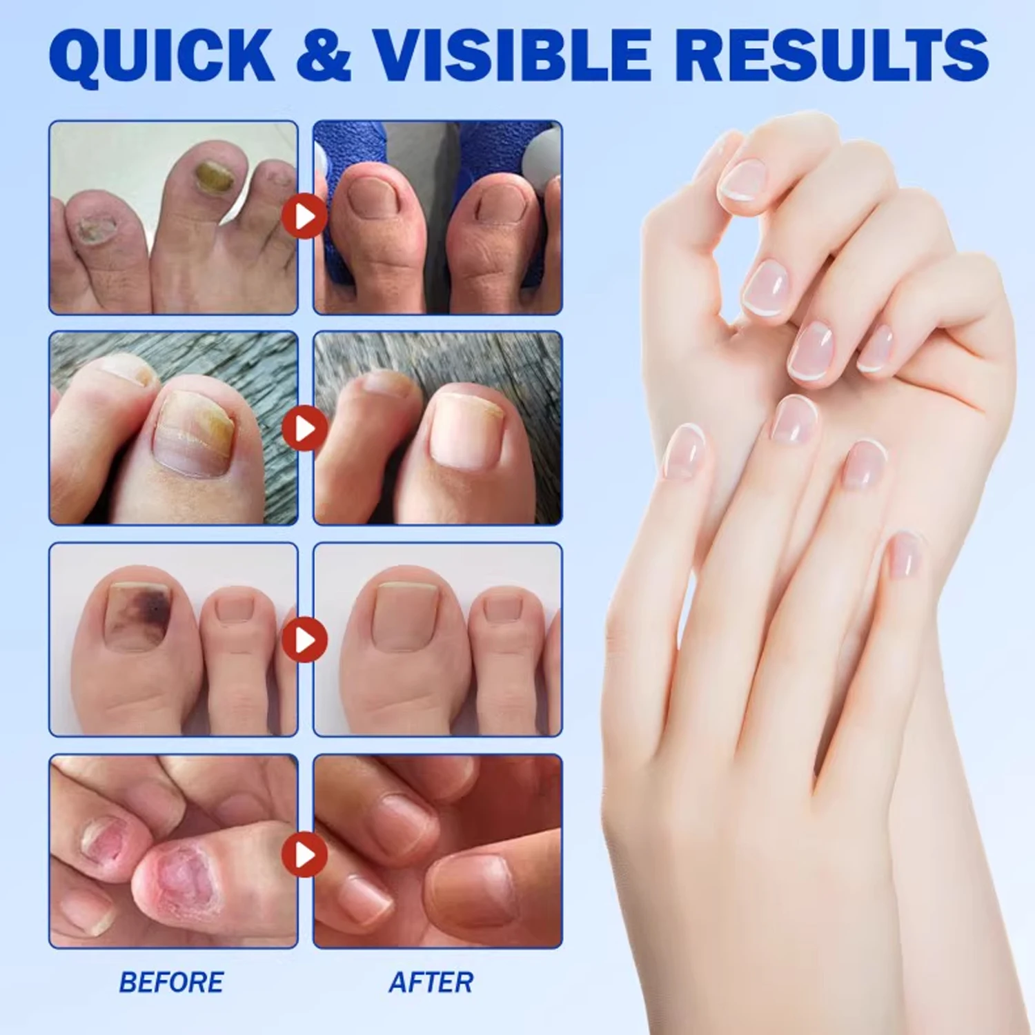 Ingrown Toenail Correction Patch Waterproof Nail Repair Tool Set_voghion.com