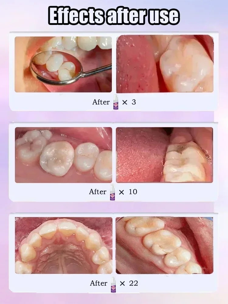 Toothpaste for Teeth Whitening Cavities Caries Removal Plaque Stains Decay Repair Dental Calculus