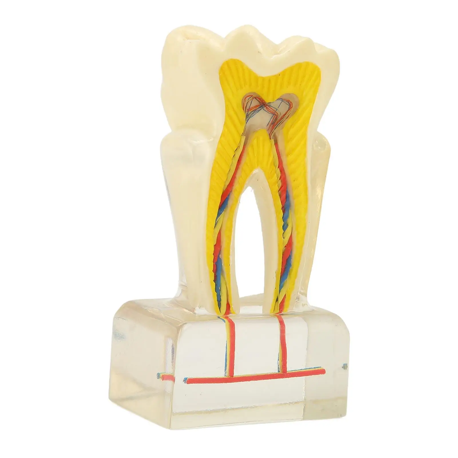 

Dental Education Supplies: Acrylic 6X Decayed Tooth Model