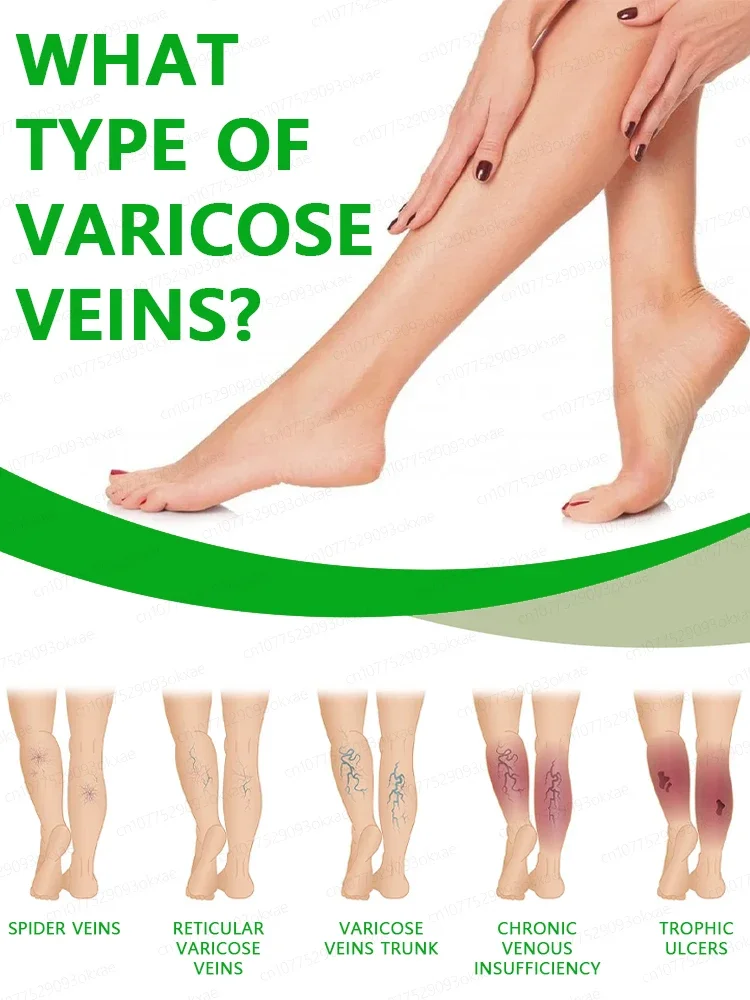 

quickly repair varicose veins and vasculitis