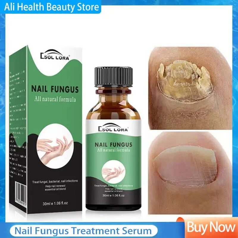 

Nail Fungus Treatment Serum Repair Fungus Removal Essence Liquid Onychomycosis Foot Care Gel Anti Infection Thicken Soft Nails